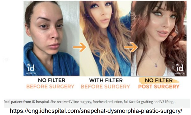 Images of the same woman before and after surgery to make her look like a computer filtered face.